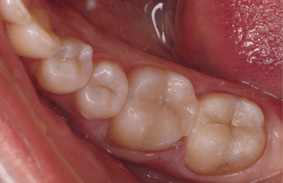 cerec-after