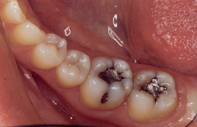 cerec-before