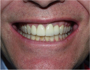 After Dental Crowns