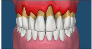 Periodontal Diseased Gums