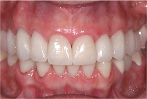 After Porcelain Veneers